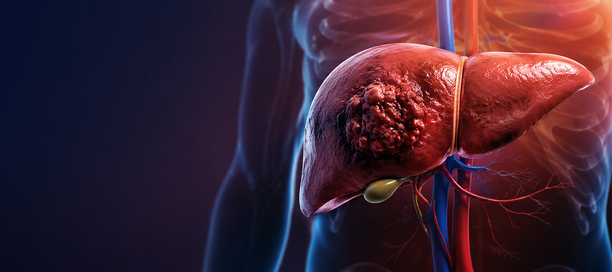 What Really Causes Liver Cancer? Top Risk Factors You Should Know